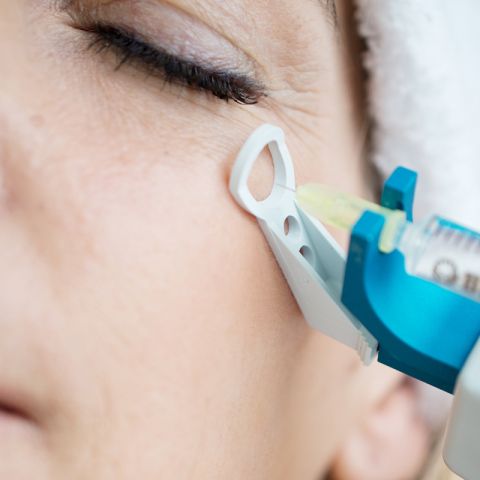 Gesicht Frau bei der Mesotherapie-Behandlung
